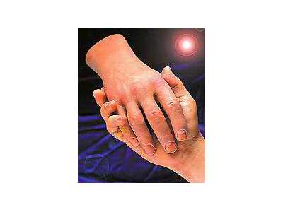 Alatheia Prosthetics For Amputees 